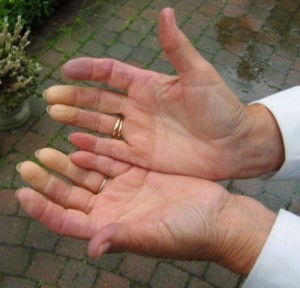 Raynauds feneomen sklerodermi