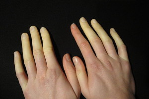 Raynauds er Likfingre