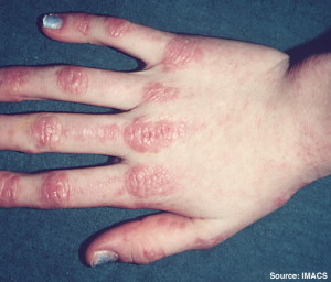 Dermatomyositt. "Dermatomyositis" by Elizabeth M. Dugan, Adam M. Huber, Frederick W. Miller, Lisa G. Rider - http://dermatology.cdlib.org/1502/reviews/photoessay/1.jpg. Licensed under CC BY-SA 3.0 via Wikimedia Commons - http://commons.wikimedia.org/wiki/File:Dermatomyositis.jpg#/media/File:Dermatomyositis.jpg