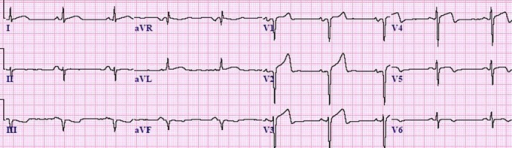 takotsubo cardiomyopathy symptoms