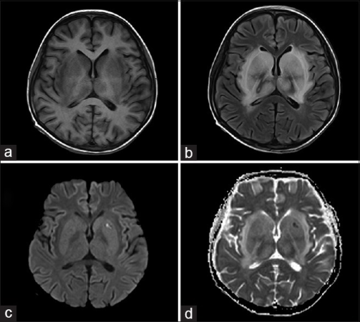 Cns Lupus Systemic Lupus Sle In Brain And Or Spinal Cord Bindevevssykdommer Nobindevevssykdommer No