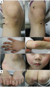 Jevenil Dermatomyosite