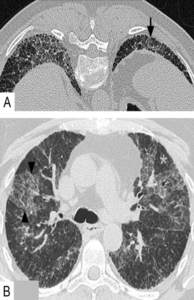 Lungefibrose på CT bilde