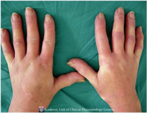 This image is missing alt text; its filename is Systemic-Sclerosis-Hands-Early-Cutolo-PMC2935167_IJR2010-784947.001-300x231.png