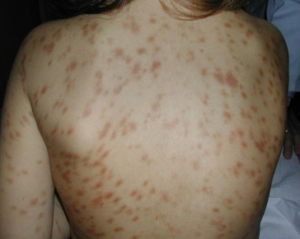 Mastocytosis in the skin