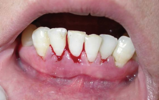 Periodontitt og leddgikt/revmatoid artritt. Torkzaban P, Hjiabadi T, Basiri Z, Poorolajal J - Journal of periodontal & implant science (2012). CC BY-NC3.0 